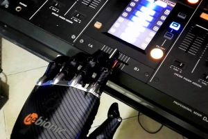 myoelectric prosthesis