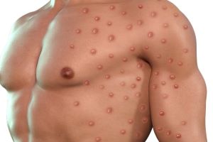 monkeypox disease