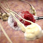 metastatic cancer cryoablation