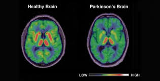 Parkinson's brain