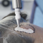 skin cancer treatment