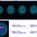 Spect Datscan Parkinson's