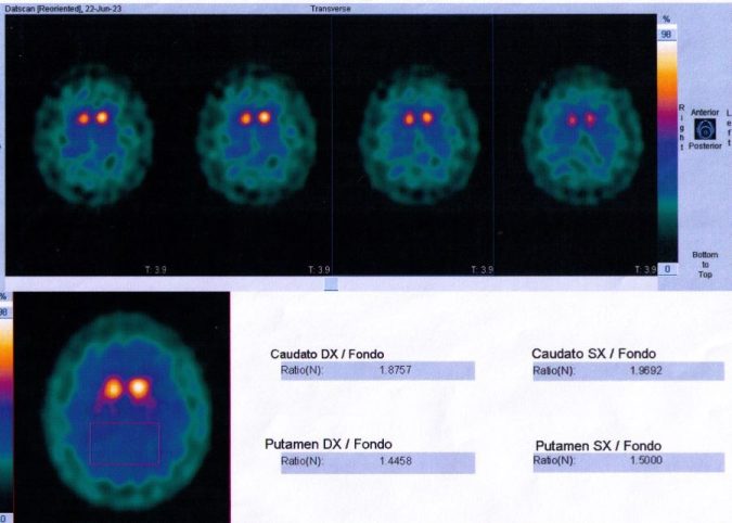 Spect Datscan Parkinson's