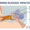 earwax blockage