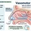 vasomotor rhinitis