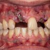 dental vasculitis