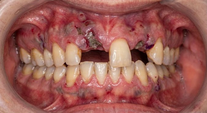 What Is Vasculitis? Your Dentist Knows It dental vasculitis